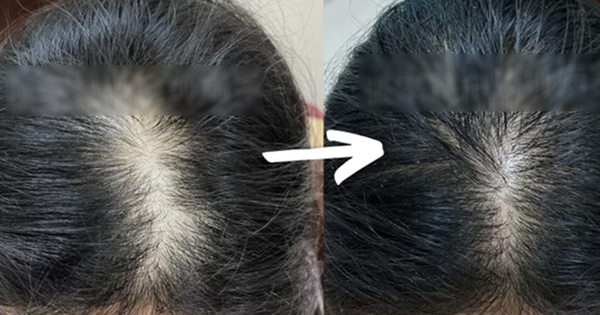 TẠI SAO NGƯỜI TRẺ CŨNG BỊ RỤNG TÓC VƯỢT LÊN SO VỚI BẠN NGHỀN?
